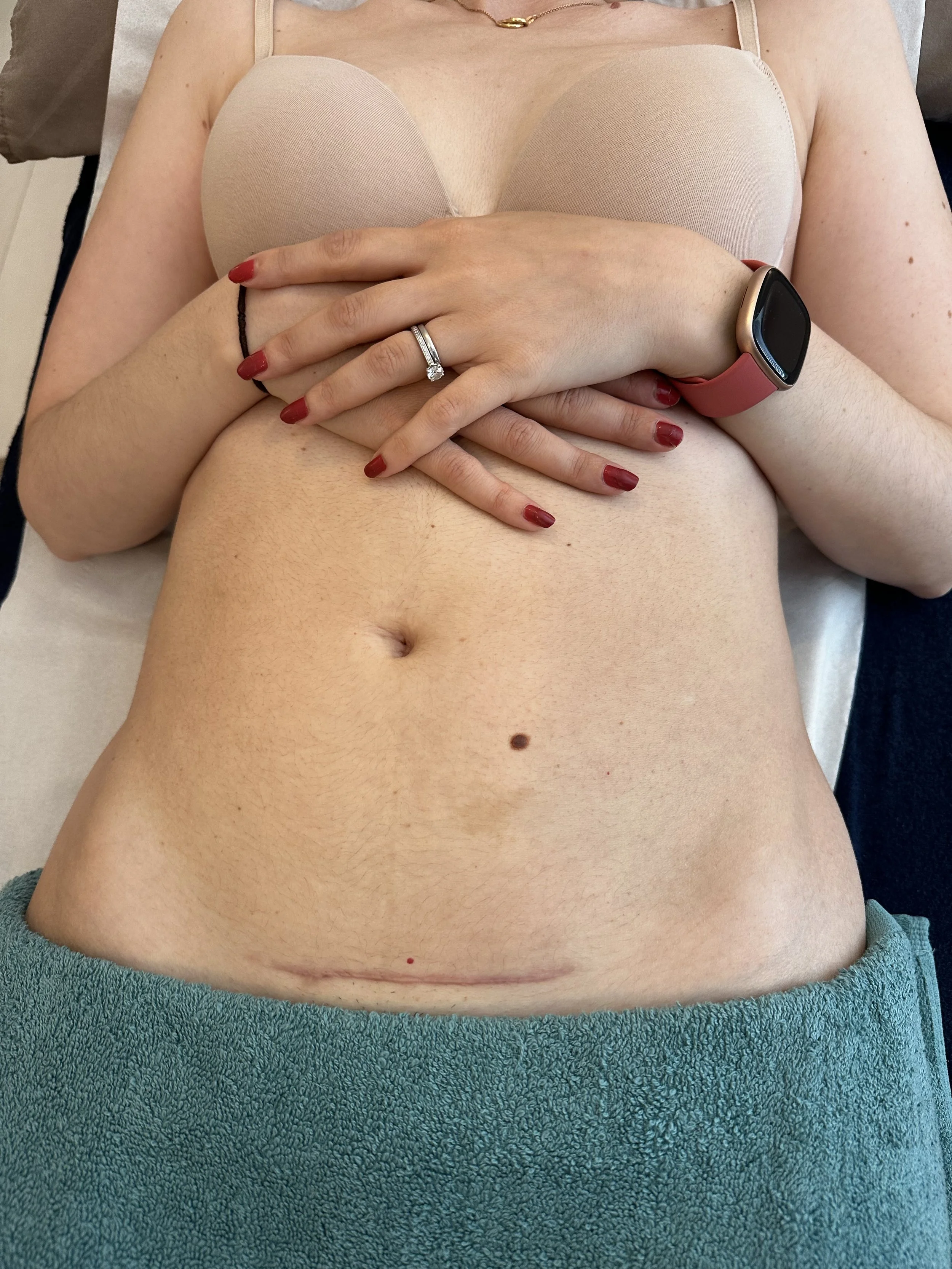 c-section scar recovery treatment at MFB Osteopathy Hoddesdon