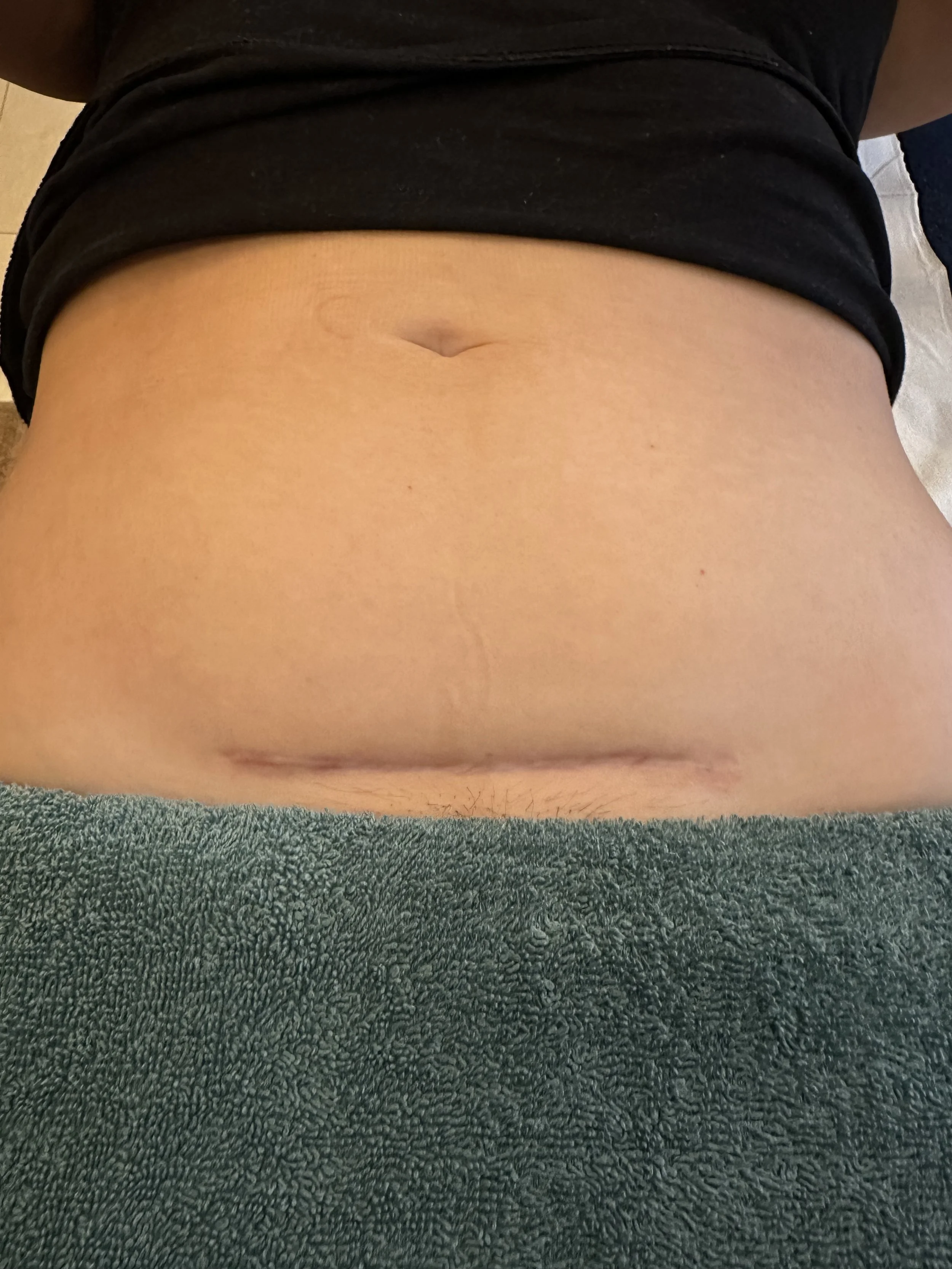 osteopath supporting postnatal recovery and scar rehab Hoddesdon