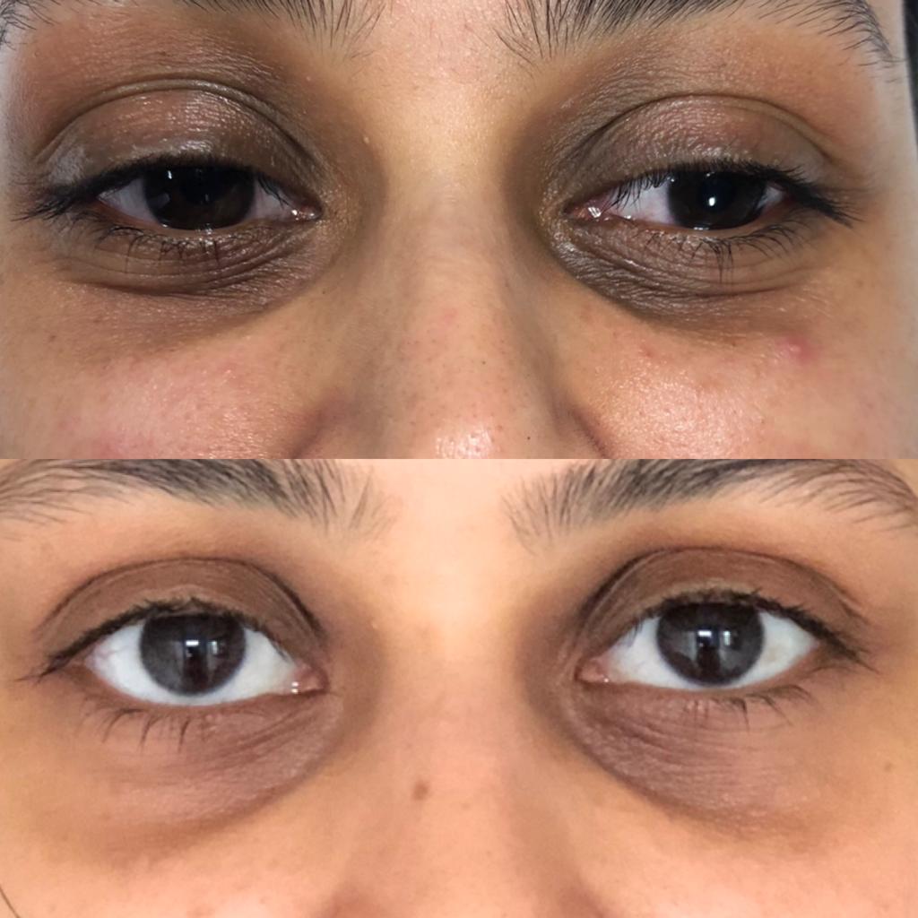 blackheads removal 2021