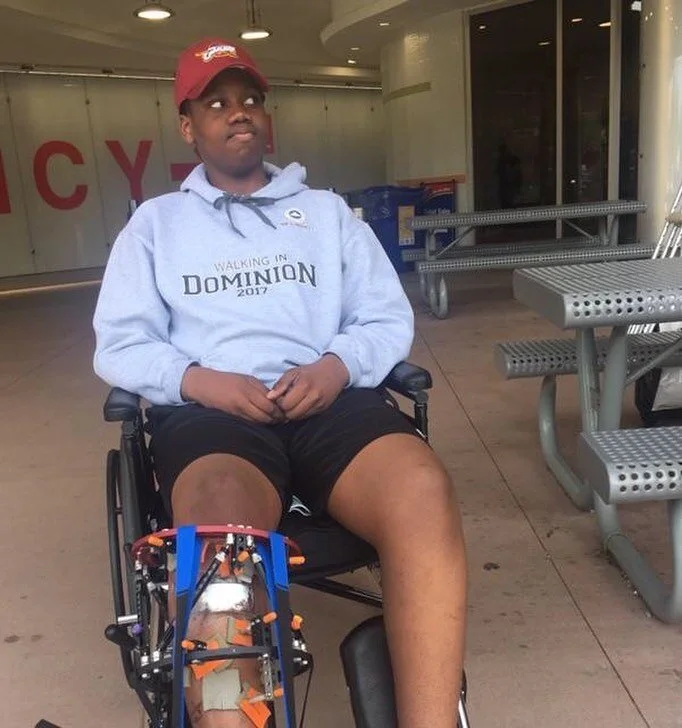 Meet Emmanuel, our basketball all-star!

At thirteen years old, he was diagnosed with Blounts disease. This caused his right leg to be shorter than the other and bow outwards below his knee.  In 2017, Dr. Cooper applied an external fixator to correct