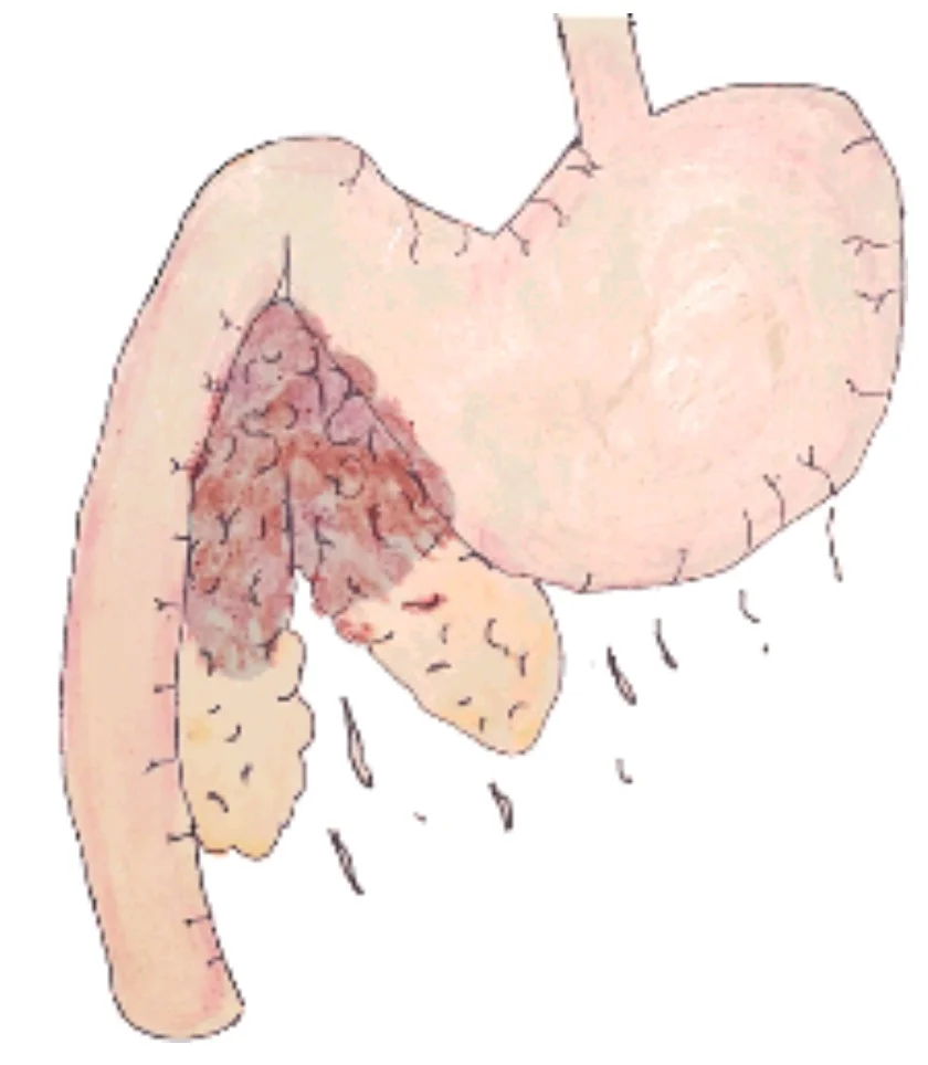 Canine Stomach and duodenum with inflamed pancreas