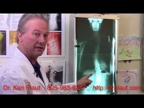 How to manage Scoliosis (Copy)