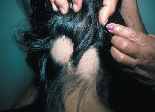 Alopecia Areata Treatment Atlanta — Hair Loss Treatment Clinic — Nina Ross  - Atlanta Trichology