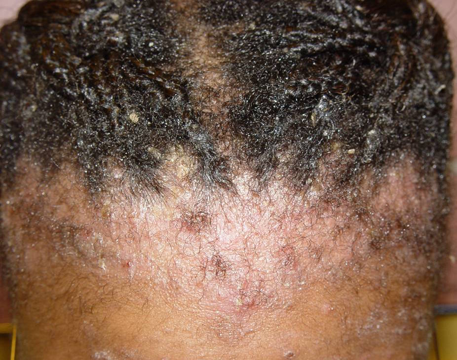 Eczema Scalp Black People What Seborrheic Dermatitis Looks Like On Eczema Scalp Black People What Seborrheic Dermatitis Looks Like On
