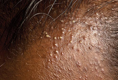 Scalp Inflammation Treatment Atlanta — Hair Loss Treatment Clinic — Nina  Ross - Atlanta Trichology