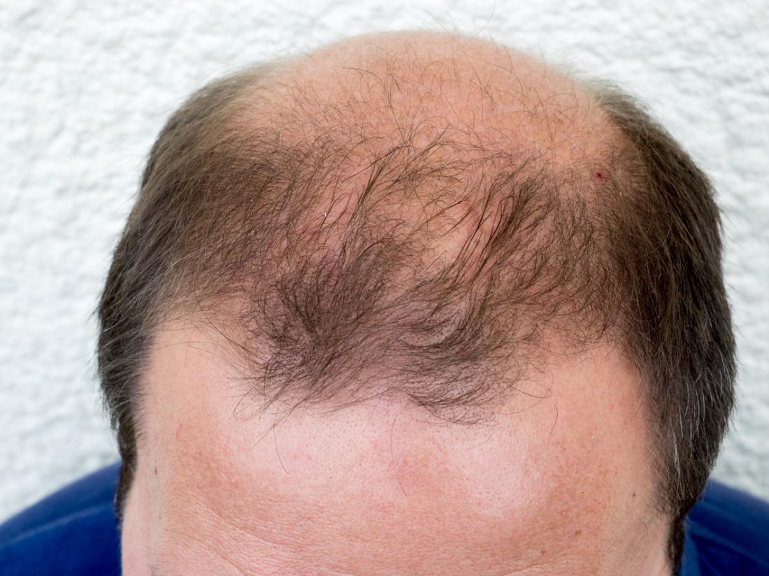 Male Pattern Baldness Treatment Atlanta — Hair Loss Treatment Clinic — Nina  Ross - Atlanta Trichology