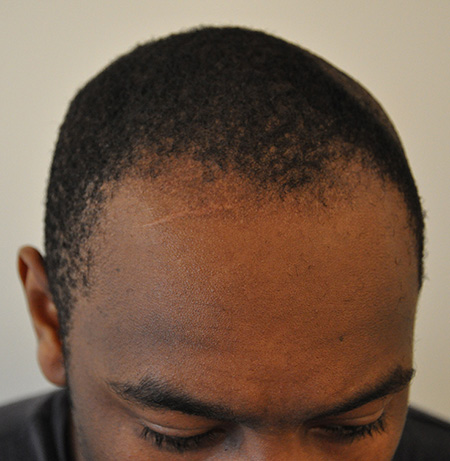 Male Pattern Baldness Treatment Atlanta Hair Loss Treatment Clinic Nina Ross Atlanta Trichology