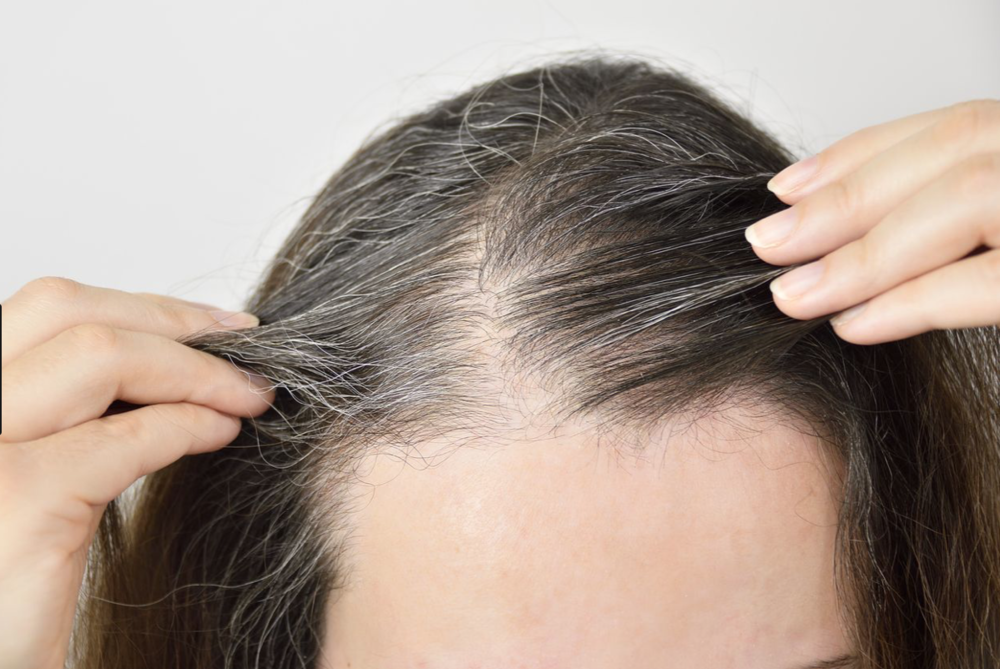 Telogen Effluvium — Hair Loss Treatment Clinic — Nina Ross - Atlanta  Trichology