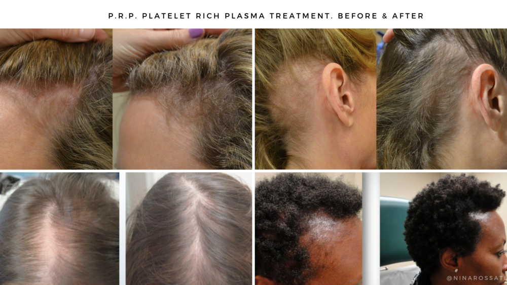 Before and After Photos — Hair Loss Treatment Clinic — Nina Ross - Atlanta  Trichology