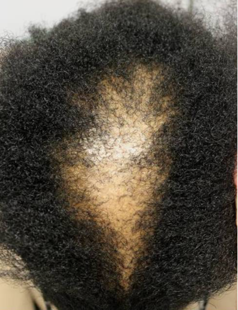 CCCA | The Most Common Cause of Hair Loss in Black Women