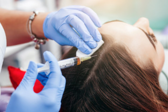 Platelet Rich Plasma and Mesotherapy for Hair Loss Before and After Results!