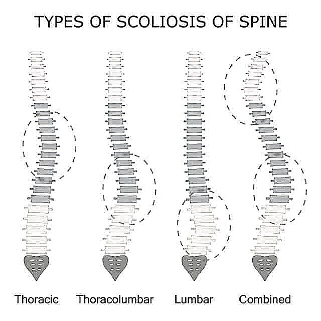 types-of-Scoliosis+%281%29.jpg