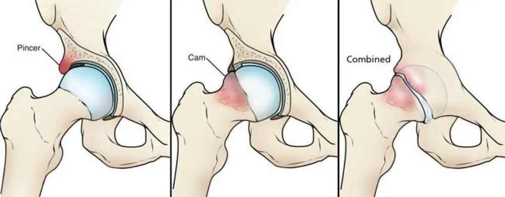 Hip Pain? Is Femoral Acetabular Impingement (FAI)  the source of my pain?