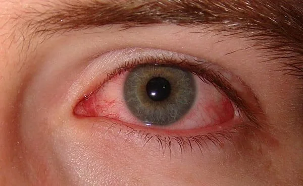 Dry Eye Disease: Symptoms, Causes &amp; Treatment in Staten Island, NY