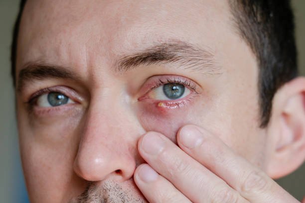 Stye on Your Eyelid? Here's What You Need to Know