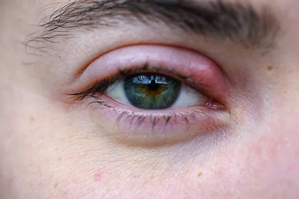 Why Do I Keep Getting Styes?