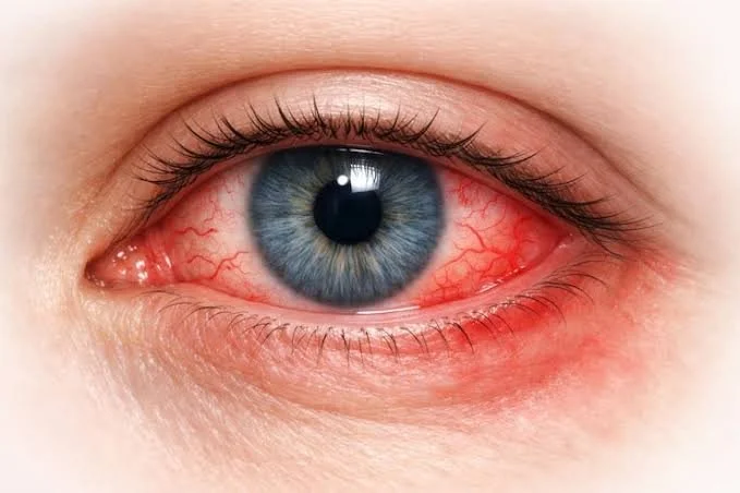 How to Prevent Eye Infections: Simple Tips for Healthy Eyes