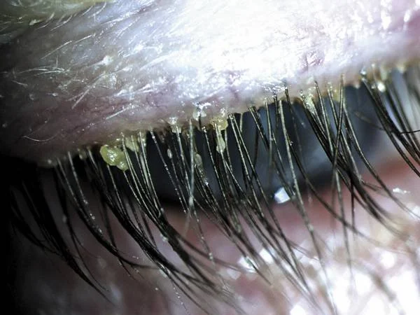 What Are Demodex Mites?