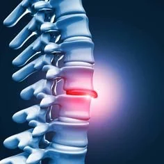 Herniated Discs: How Chiropractic Care and StemWave Therapy Support Natural Healing