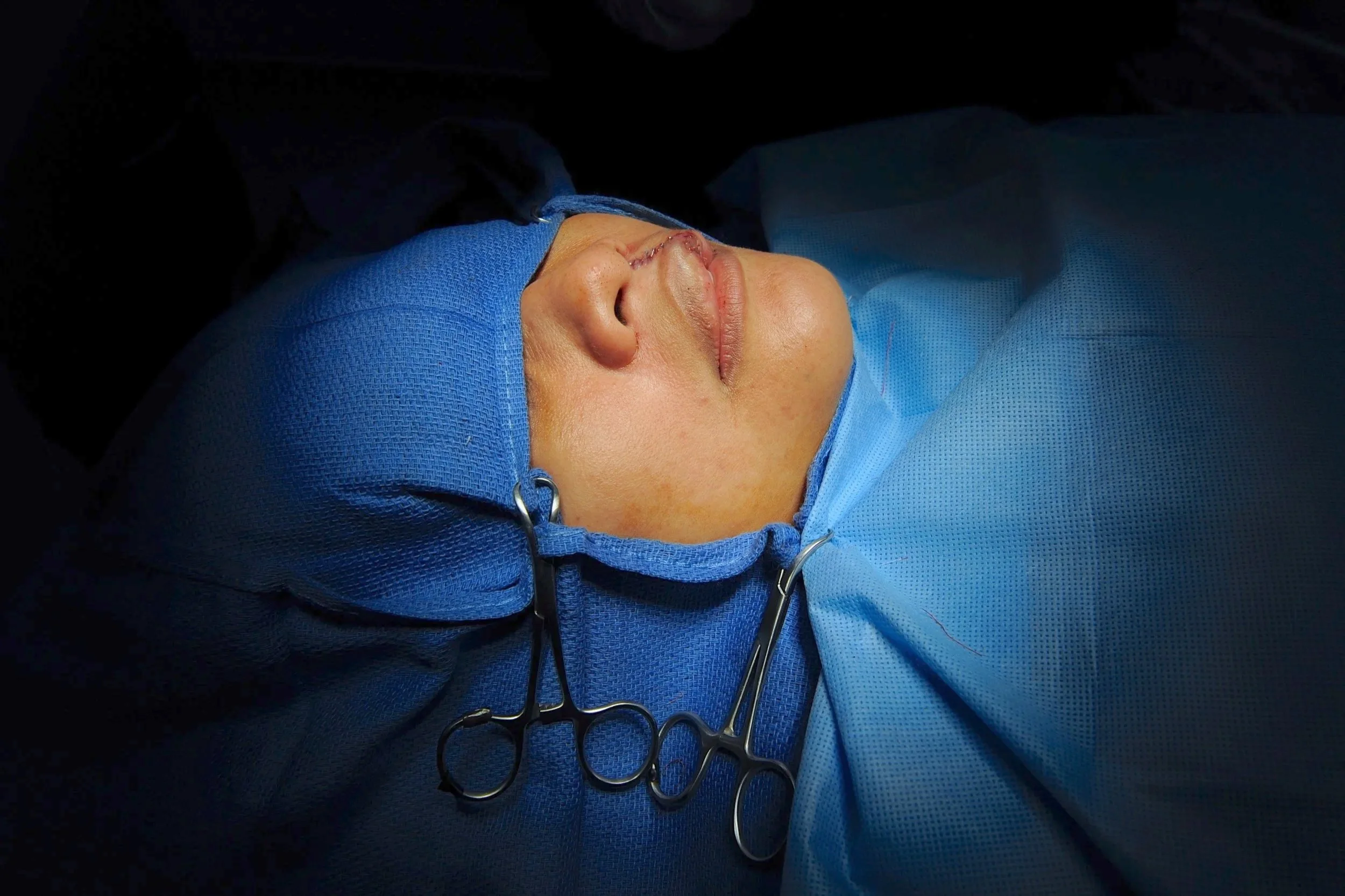 Patient after cleft lip and cleft palate surgery. Alliance for Smiles.