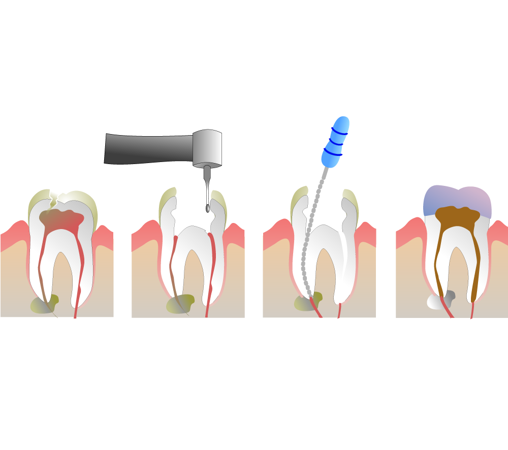 Root Canal Molar Illustration