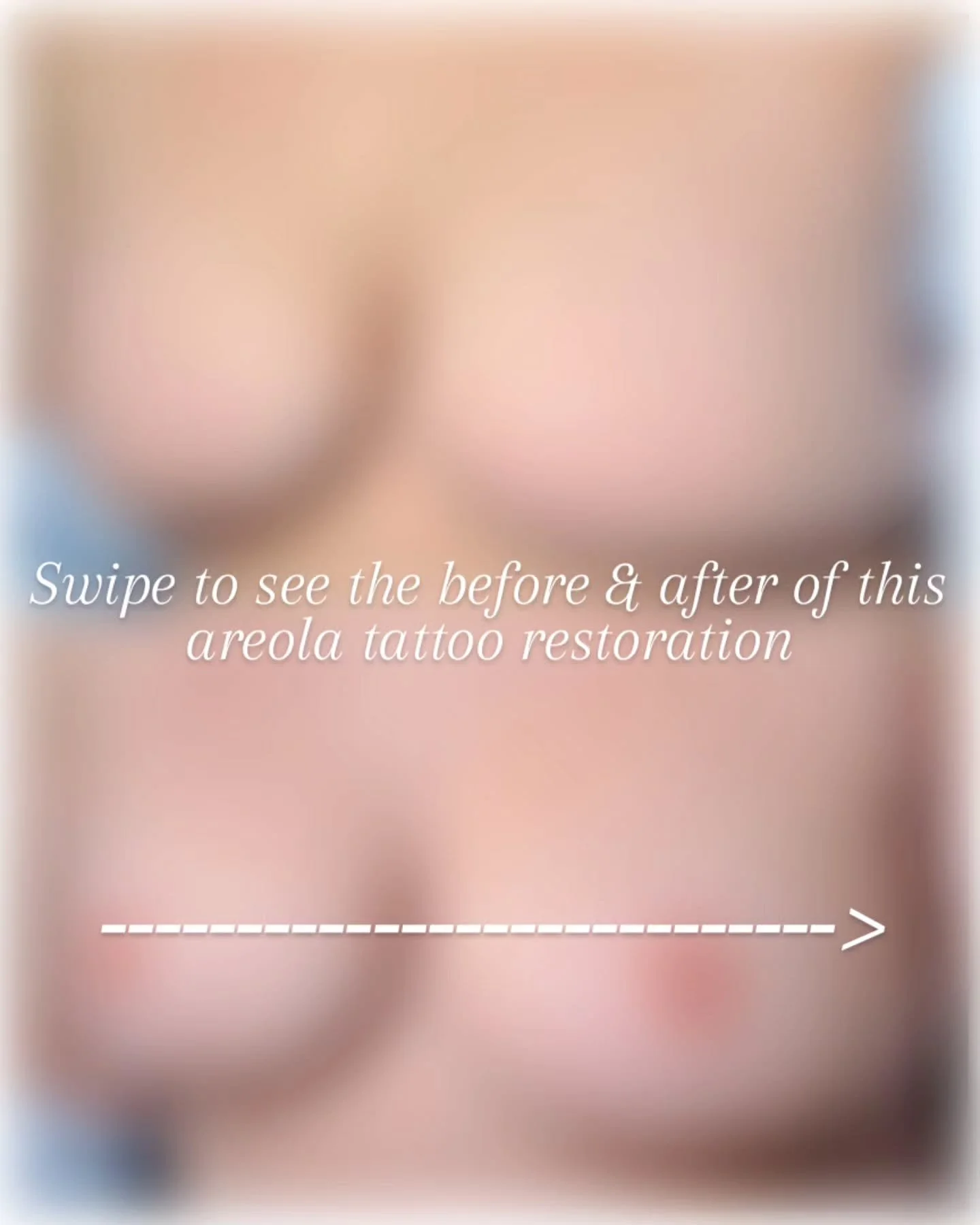 Some women carry the breast cancer gene and choose to take a proactive step to protect their health. This incredible client underwent a double mastectomy as a preventative measure and later breast reconstruction.

While reconstruction can restore the