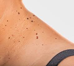 skintag.jpg