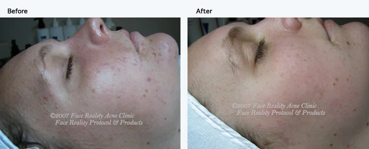 noninflamed_acne_small.jpg