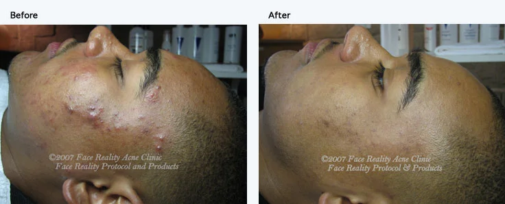 inflamed_acne_hyperpigmentation_small.jpg