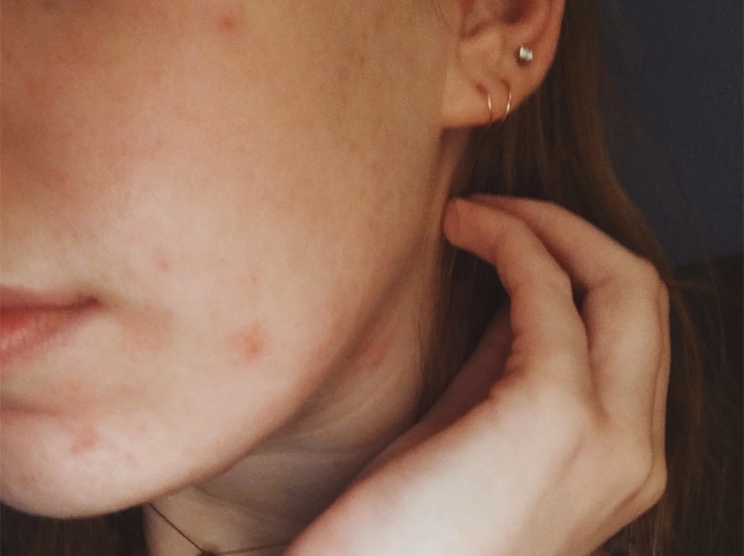 Breaking Barriers / An Acne Journey