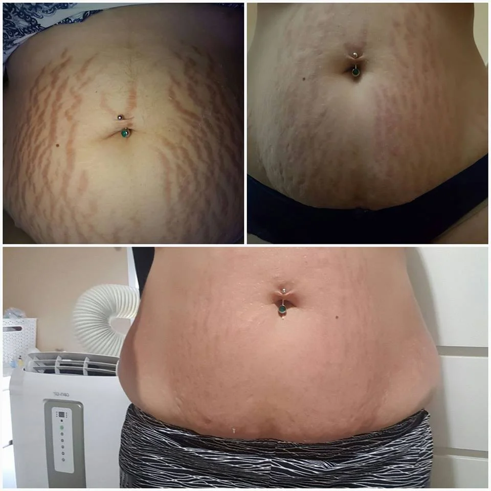 stretchmarks.jpg