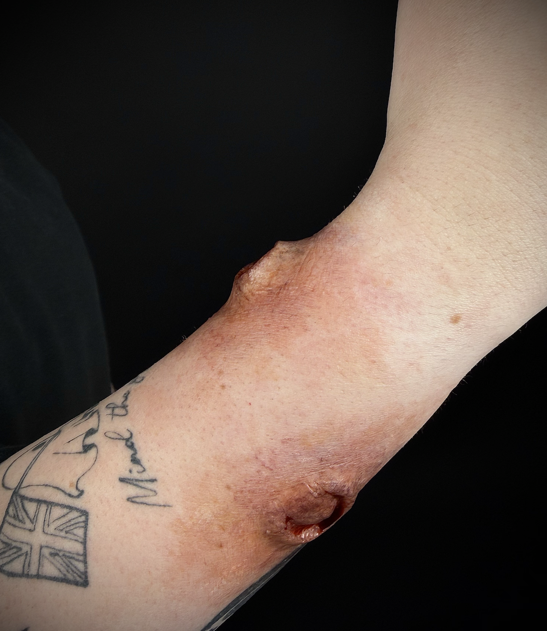 wound.png