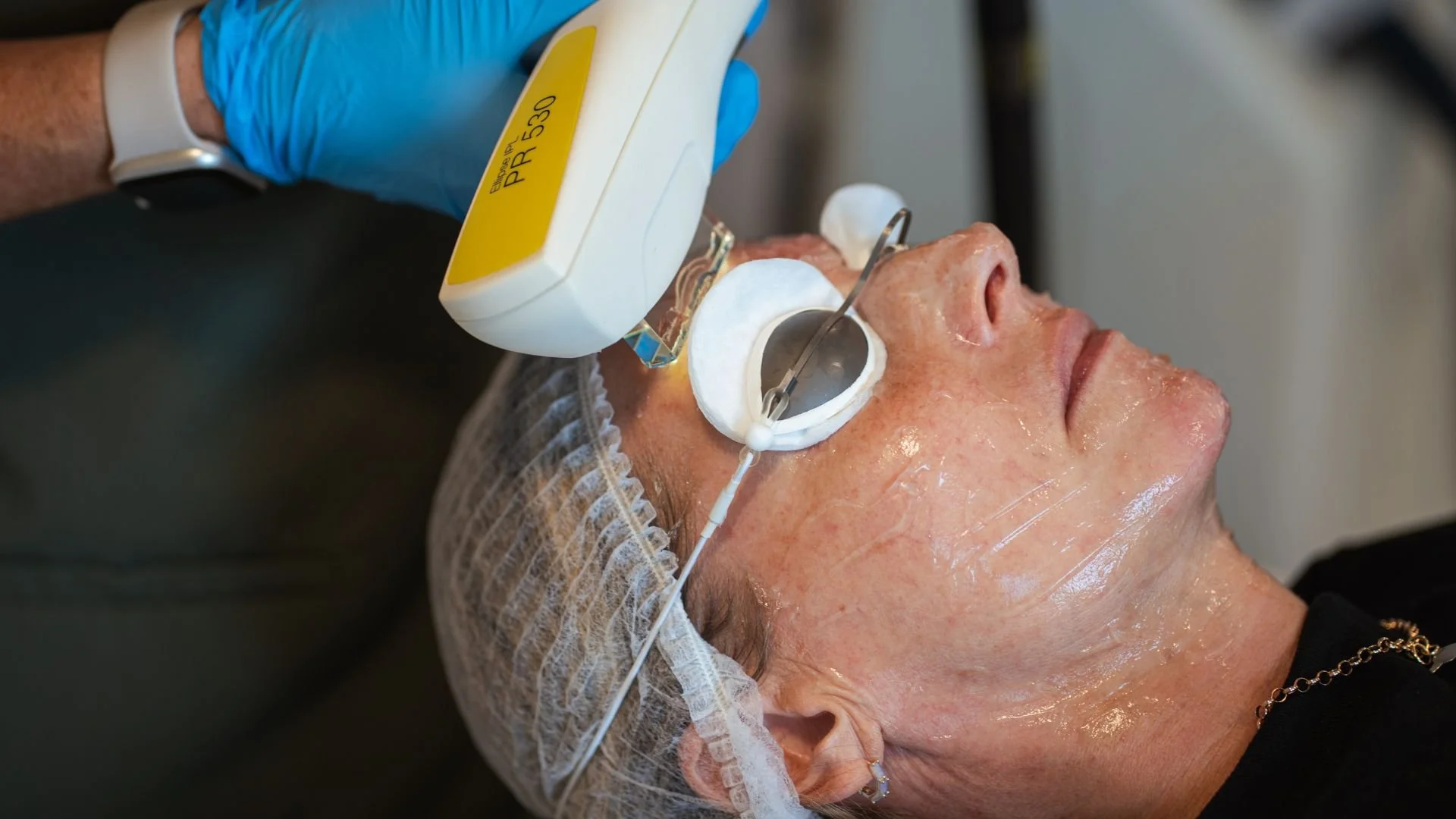 A close up of a lady's face during an IPL skin rejuvenation treatment