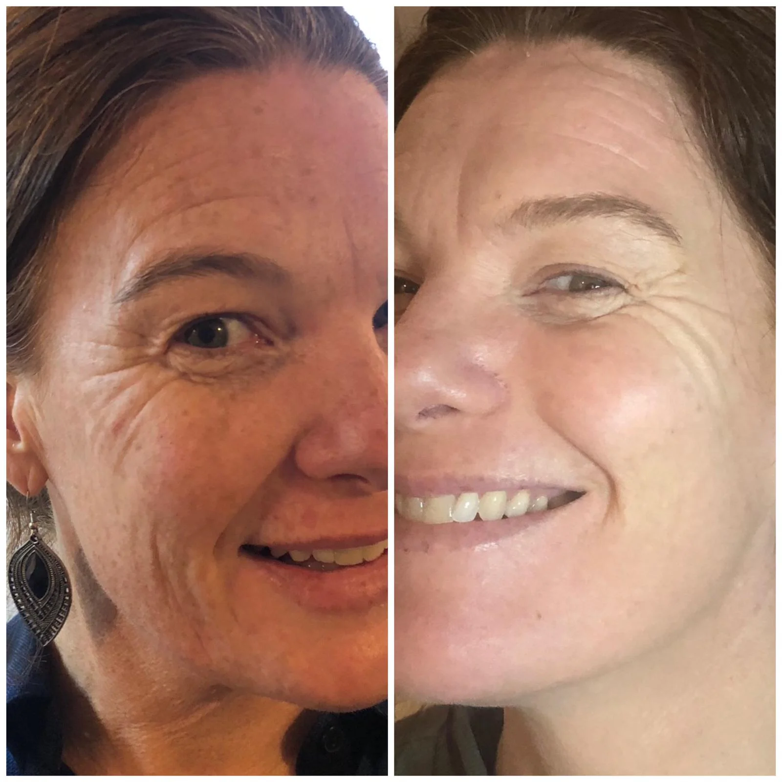 Skin Rejuvenation for Oily Acne Prone Skin
