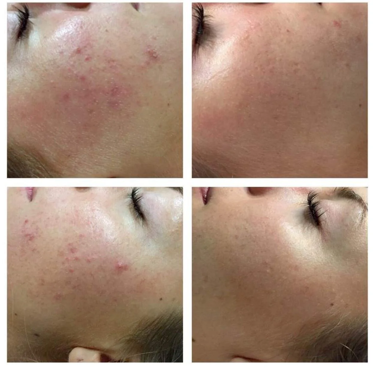 The Scar and Poor Skin Texture Guide