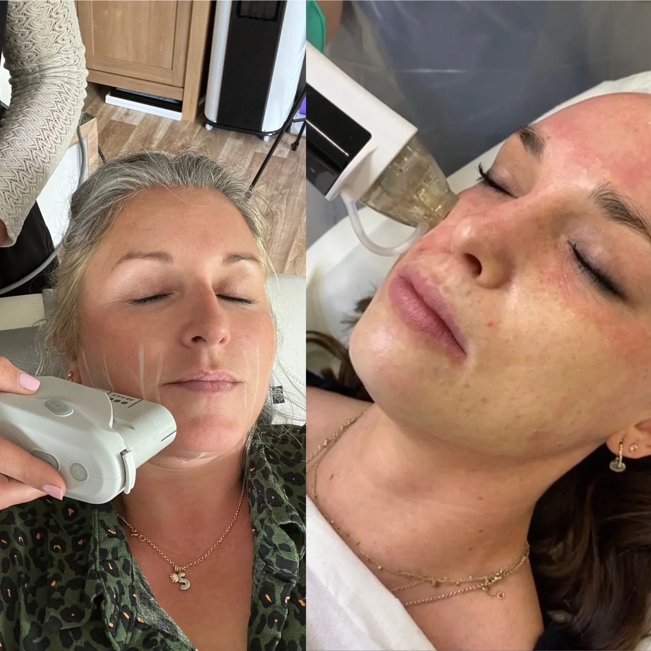 Whats The Difference Between RF Microneedling and HIFU