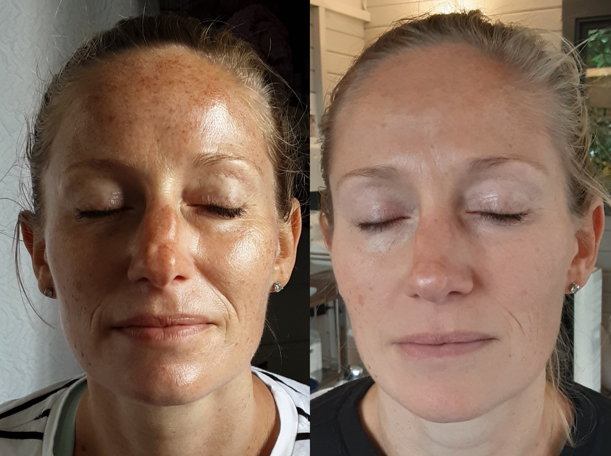 What is regenerative medicine and what can it be used for in aesthetics?