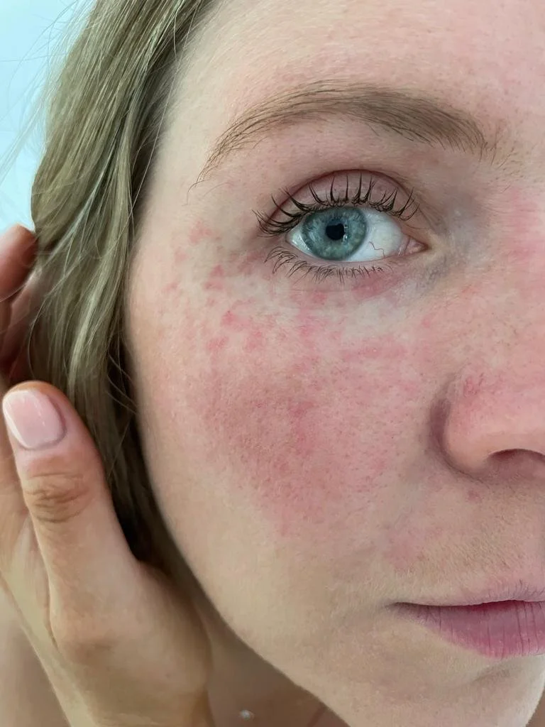 How to look after damaged skin during the winter 