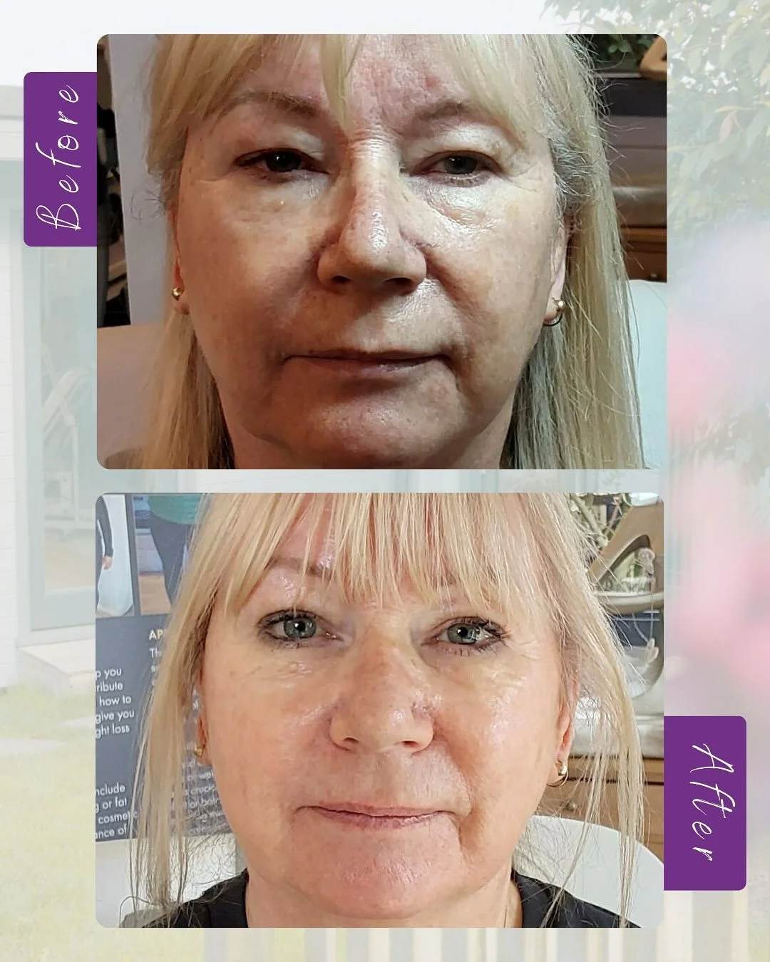 ✨ Glowing radiant skin ✨

Meet Jane, one of our incredible clients whose skin journey - ✨ The Ultimate Transformation ✨ - has been nothing short of breathtaking! 

💜 Jane came to us wanting more than a quick fix. She wanted to feel like herself agai