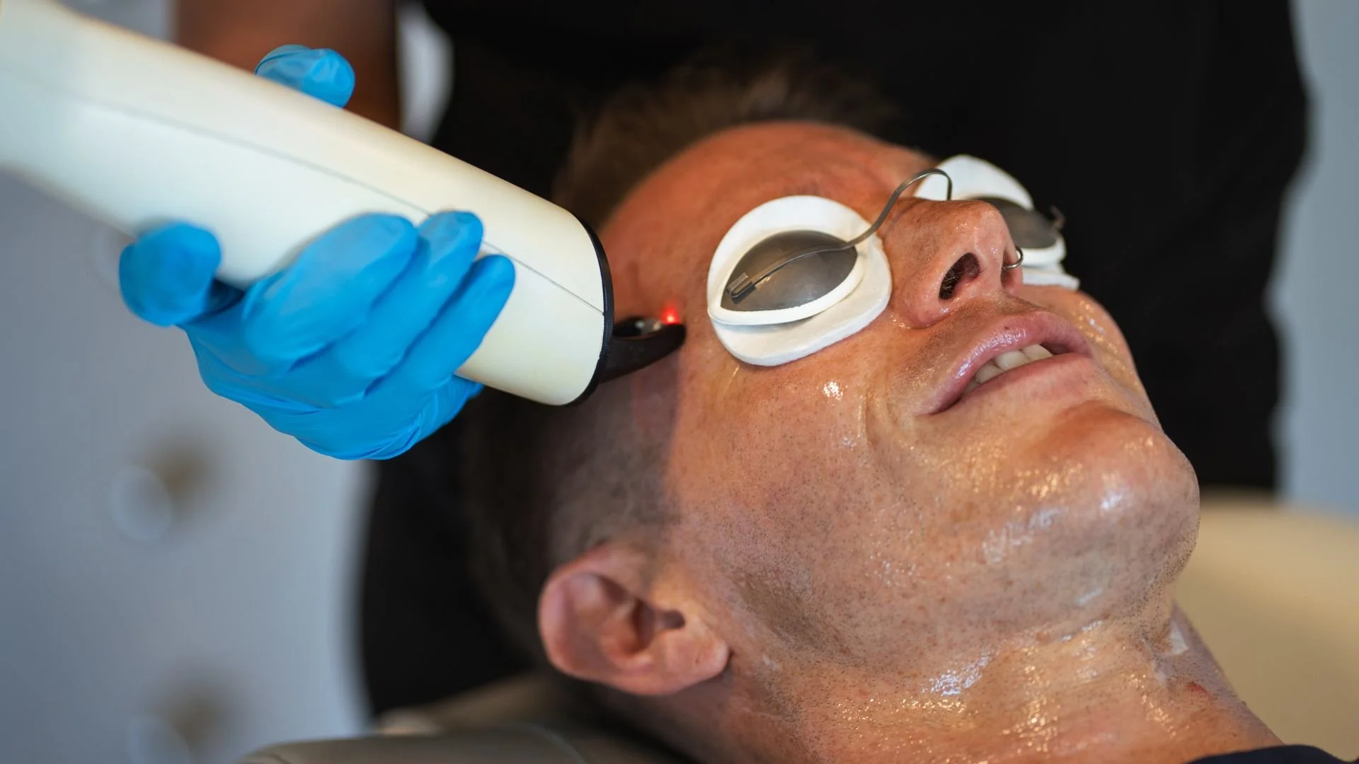 A close up of a man's face during a laser skin resurfacing treatment
