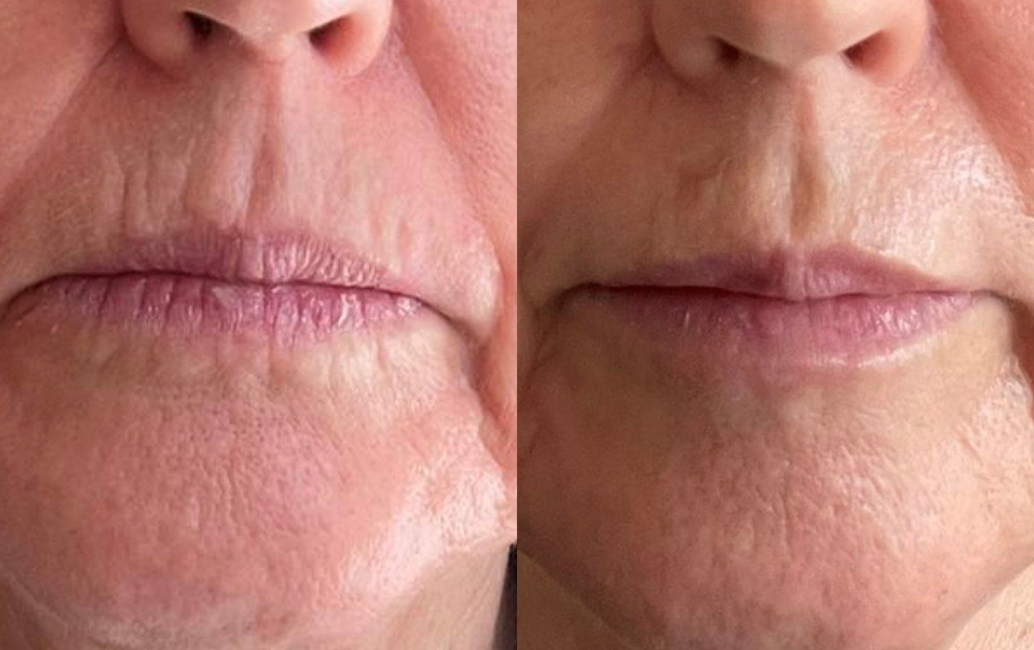 Using Botox for Lip Lines