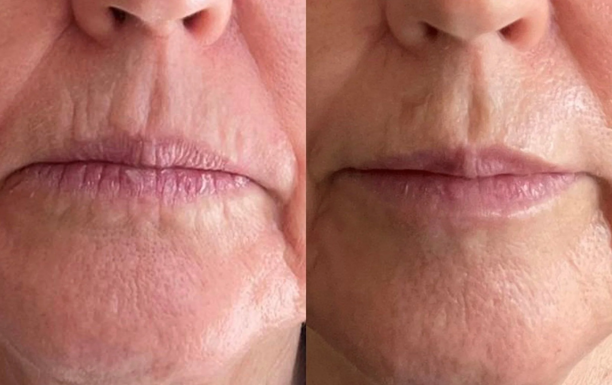NonSurgical Face and Lip Line Treatment — Winchester The Secret