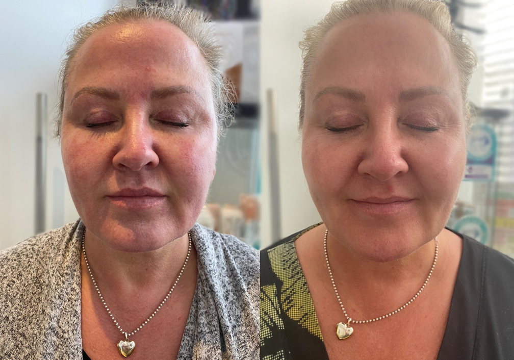 HIFU: The Secret To Judy Murray's Non Surgical Face-Lift