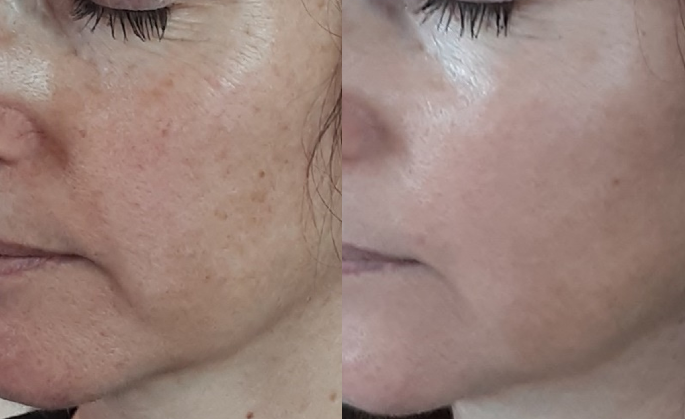 How Will Laser Face Rejuvenation Improve My Skin?