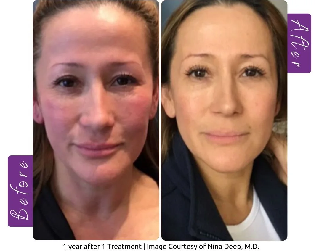 Plasma versus NeoGen: why we’ve made the switch