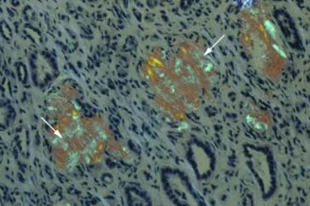 amyloidosis image.jpeg