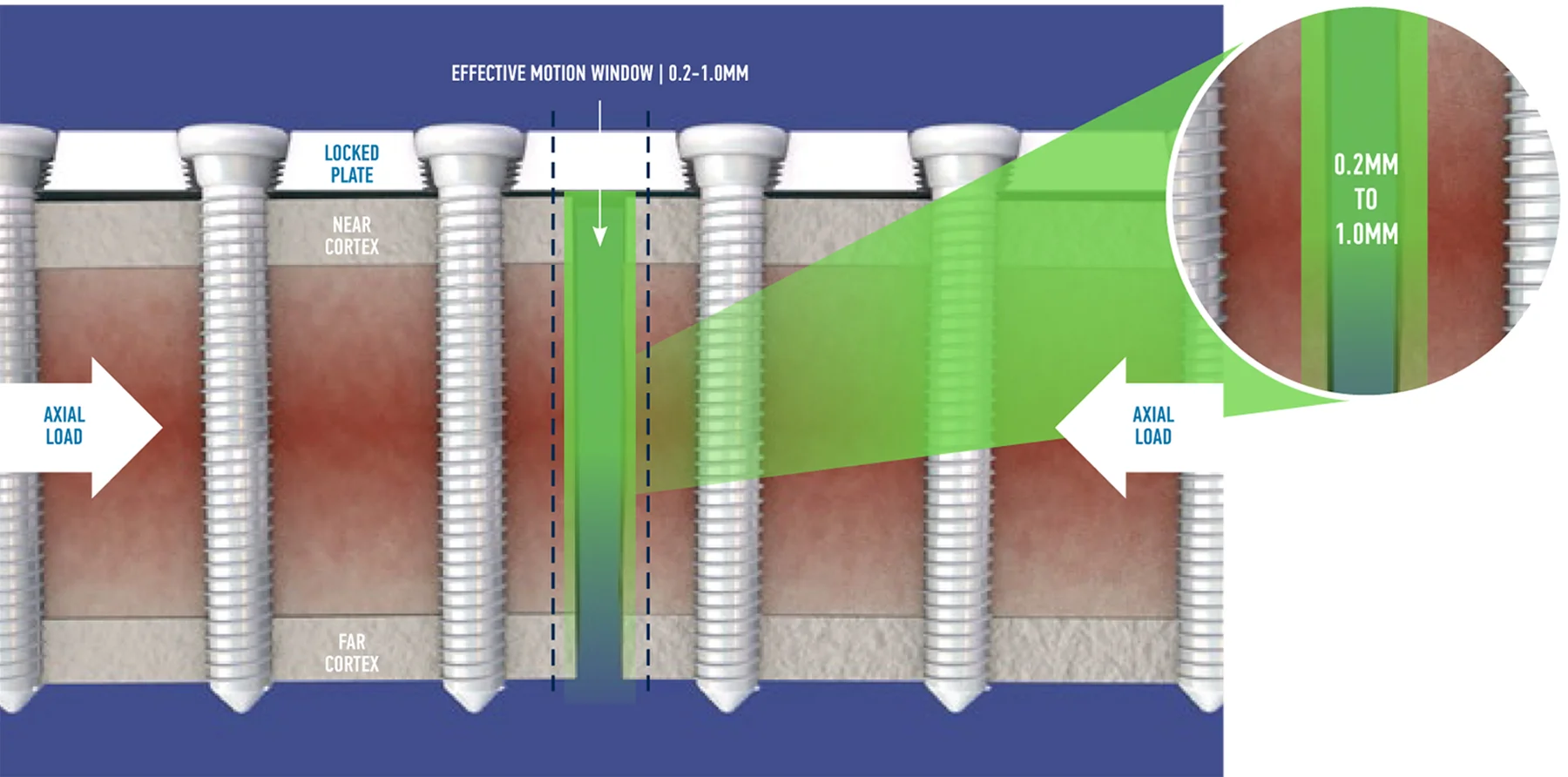Illustration depicting how, with time, SPL Locking Screws promote interfragmentary motion at both near and far bone cortices.