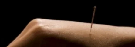 Acupuncture hand.jpg