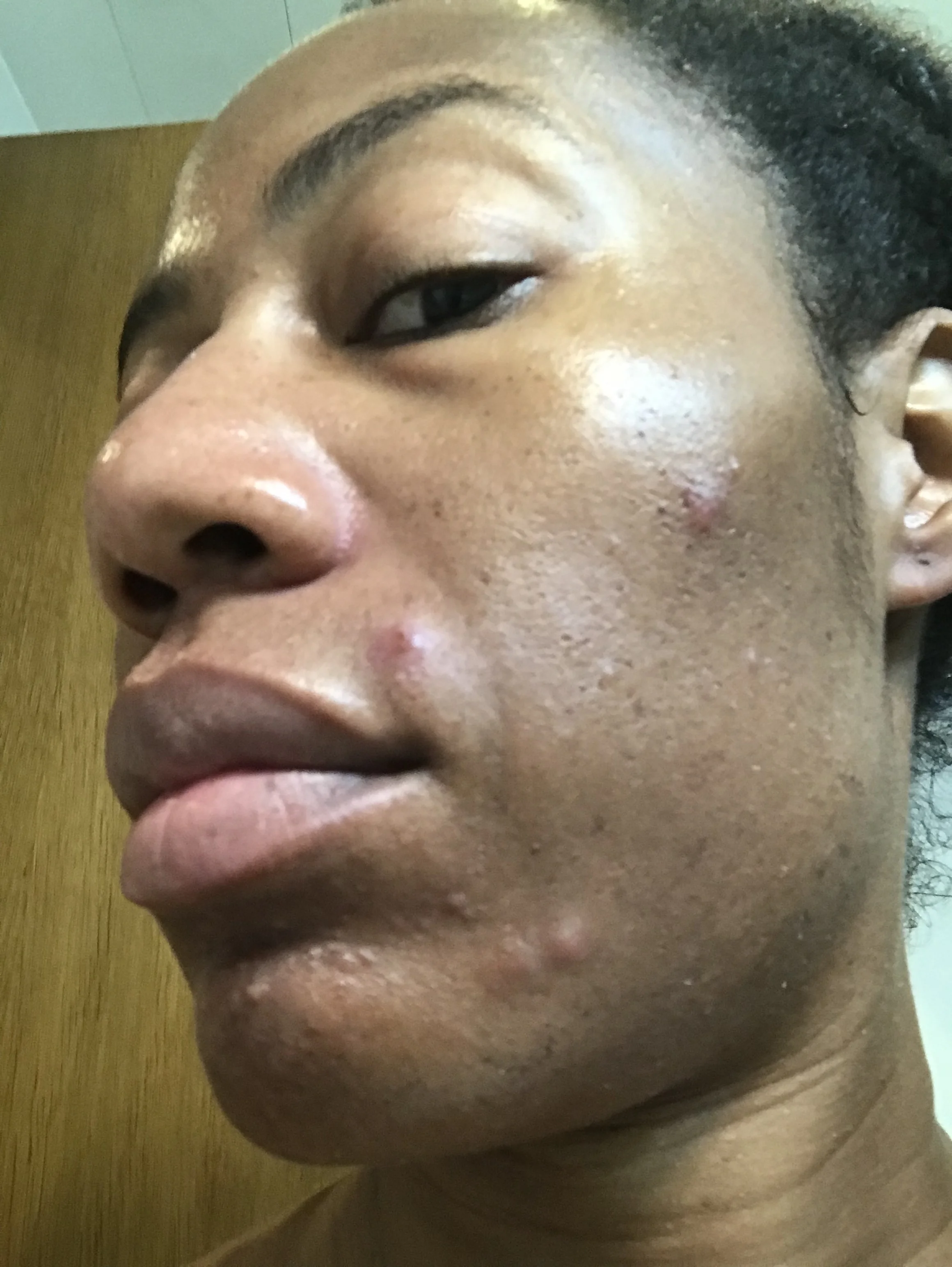 whole30 acne, whole30 cystic acne, whole 30 cystic acne