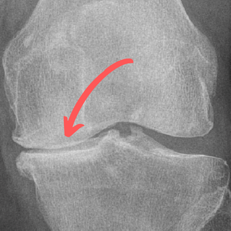 Myth Noisy Knees Are A Sign Of Osteoarthritis — Laguna Orthopedic